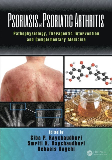 Debasis Bagchi, Smriti Raychaudhuri, Siba P. Raychaudhuri - Psoriasis and Psoriatic Arthritis, E-bok