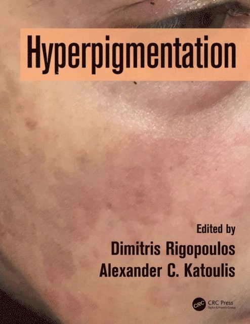 Alexander C. Katoulis, Dimitris Rigopoulos - Hyperpigmentation, E-bok