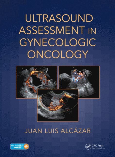 Juan Luis AlcA!zar - Ultrasound Assessment in Gynecologic Oncology, E-bok