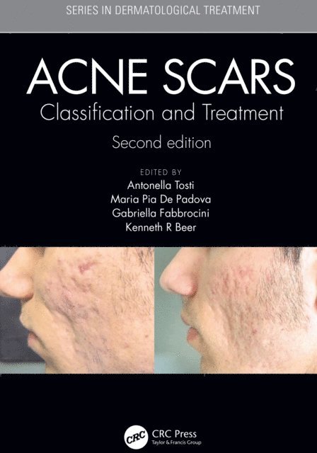 Kenneth Beer, Gabriella Fabbrocini, Maria Pia De Padova, Antonell Tosti - Acne Scars, E-bok