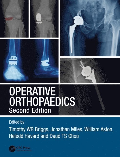 Daud TS Chou, Heledd Havard, William Aston, Jonathan Miles, Timothy WR Briggs - Operative Orthopaedics, E-bok