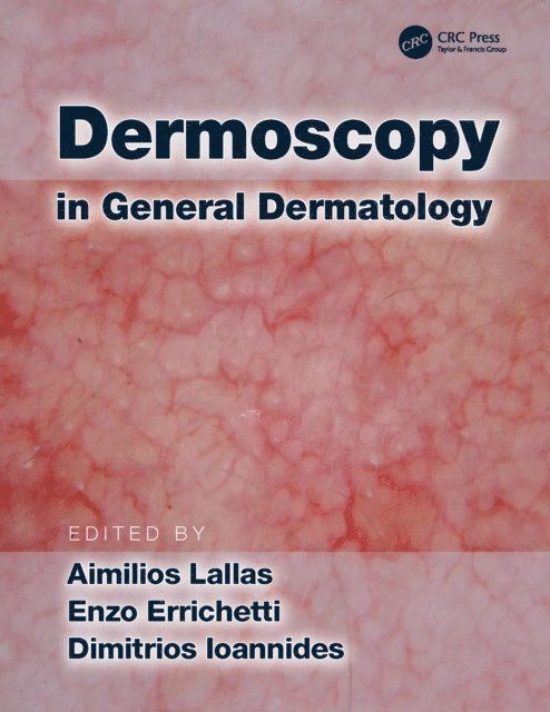 Aimilios Lallas, Enzo Errichetti, Dimitrios Ioannides - Dermoscopy in General Dermatology, E-bok