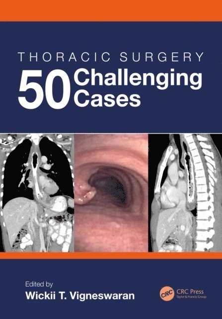 Wickii Vigneswaran - Thoracic Surgery: 50 Challenging cases, E-bok