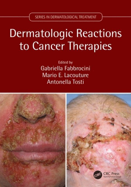 Antonella Tosti, Mario Lacouture, Gabriella Fabbrocini - Dermatologic Reactions to Cancer Therapies, E-bok