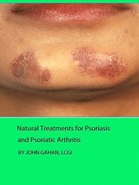 LCGI John Gahan - Natural Treatments for Psoriasis and Psoriatic Arthritis, E-bok. Tillgänglighet: Lägg i varukorg