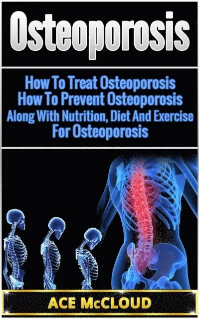 Osteoporosis: How To Treat Osteoporosis: How To Prevent Osteoporosis: Along With Nutrition, Diet And Exercise For Osteoporosis