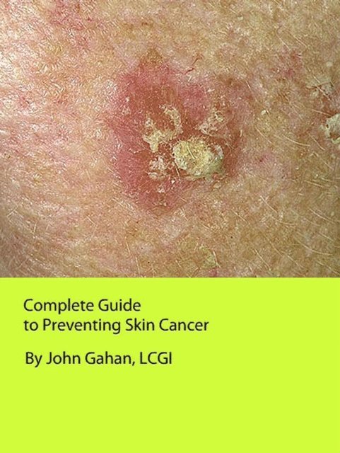 LCGI John Gahan - Complete Guide to Preventing Skin Cancer, E-bok. Tillgänglighet: Lägg i varukorg