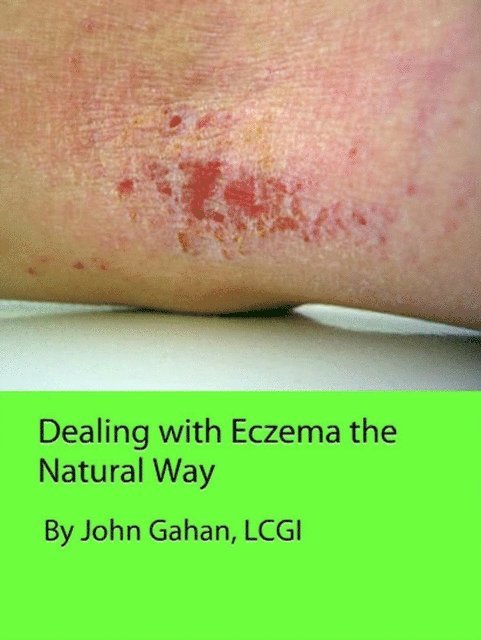 LCGI John Gahan - Dealing with Eczema the Natural Way, E-bok. Tillgänglighet: Lägg i varukorg