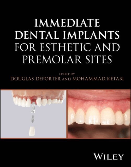 Mohammad Ketabi, Douglas Deporter - Immediate Dental Implants for Esthetic and Premolar Sites, E-bok