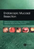 Massimo Conio, Pieter Siersema, Alessandro Repici, Thierry Ponchon - Endoscopic Mucosal Resection, Inbunden