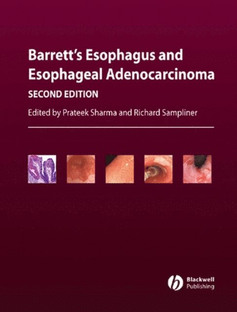Richard Sampliner, Prateek Sharma - Barrett's Esophagus and Esophageal Adenocarcinoma, E-bok
