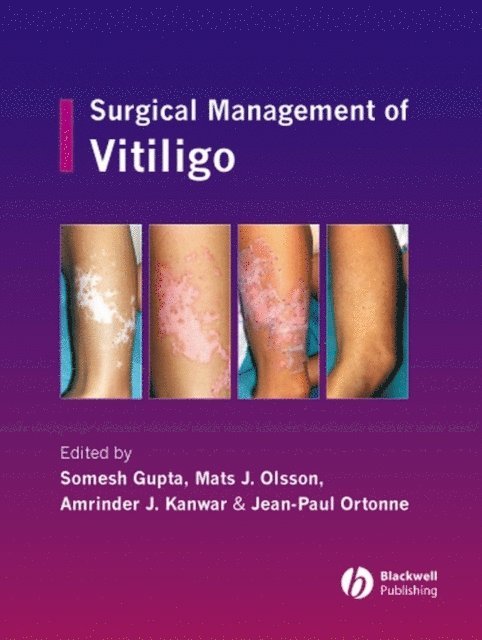 Jean-Paul Ortonne, Amrinder J. Kanwar, Mats J. Olsson, Somesh Gupta - Surgical Management of Vitiligo, E-bok