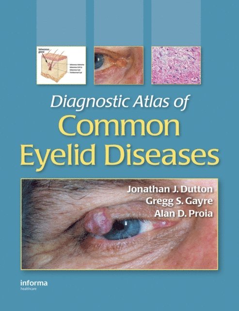 Alan D. Proia, Gregg S. Gayre, Jonathan J. Dutton - Diagnostic Atlas of Common Eyelid Diseases, E-bok