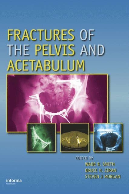 Steven J Morgan, Bruce H. Ziran, Wade R. Smith - Fractures of the Pelvis and Acetabulum, E-bok