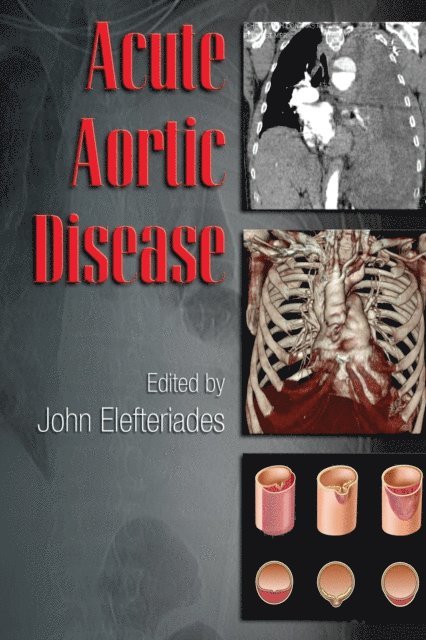 John Elefteriades - Acute Aortic Disease, E-bok