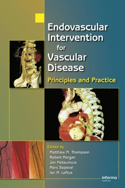 Ian M. Loftus, Marc Sapoval, Jon S. Matsumura, Robert A. Morgan, Matt M. Thompson - Endovascular Intervention for Vascular Disease, E-bok