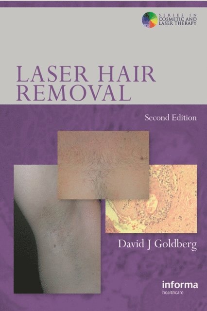 David J. Goldberg - Laser Hair Removal, E-bok
