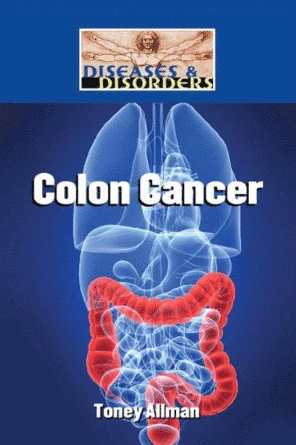 Toney Allman - Colon Cancer, E-bok