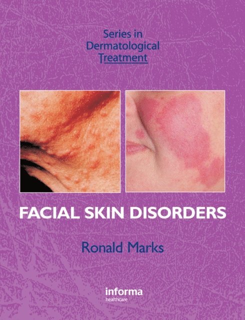Ronald Marks - Facial Skin Disorders, E-bok