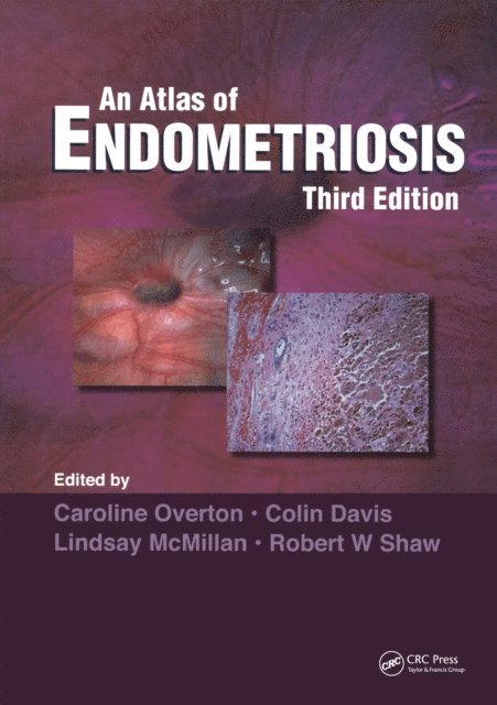Colin Davis, Lindsay McMillan, Robert W. Shaw, Caroline Overton - Atlas of Endometriosis, E-bok