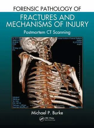 Michael P. Burke - Forensic Pathology of Fractures and Mechanisms of Injury, E-bok. Tillgänglighet: Lägg i varukorg