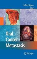 Oral Cancer Metastasis