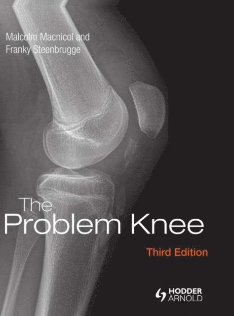 Franky Steenbrugge, Malcolm Macnicol - Problem Knee, E-bok. Tillgänglighet: Lägg i varukorg