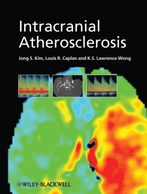 K. S. Lawrence Wong, Louis R. Caplan, Jong S. Kim - Intracranial Atherosclerosis, E-bok