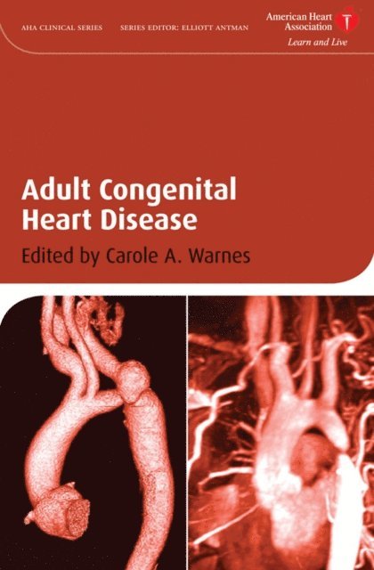 Carole A. Warnes - Adult Congenital Heart Disease, E-bok