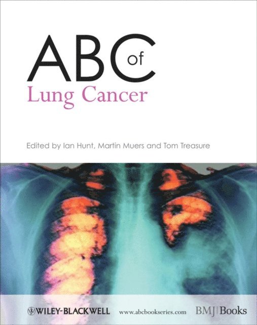 Tom Treasure, Martin M. Muers, Ian Hunt - ABC of Lung Cancer, E-bok