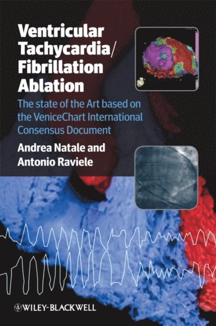 Antonio Raviele, Andrea Natale - Ventricular Tachycardia / Fibrillation Ablation, E-bok