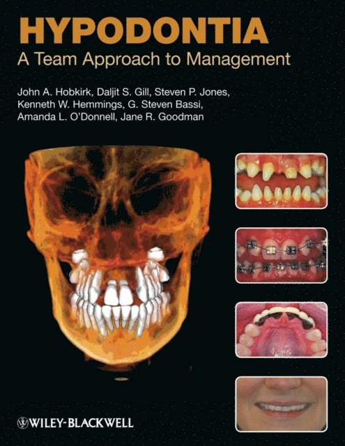 Jane R. Goodman, Amanda L. O'Donnell, G. Steven Bassi, Kenneth W. Hemmings, Steven P. Jones, Daljit S. Gill, John A. Hobkirk - Hypodontia, E-bok