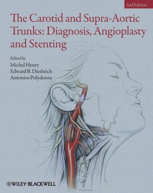 Antonios Polydorou, Edward B. Diethrich, Michel Henry - Carotid and Supra-Aortic Trunks, E-bok