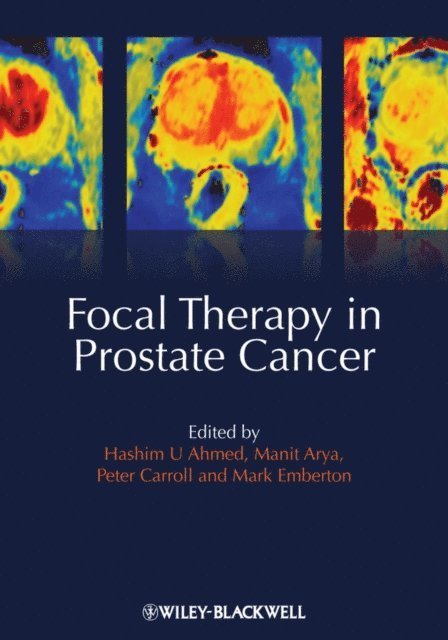 Mark Emberton, Peter R. Carroll, Manit Arya, Hashim Uddin Ahmed - Focal Therapy in Prostate Cancer, E-bok