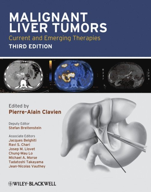 Pierre-Alain Clavien - Malignant Liver Tumors, E-bok