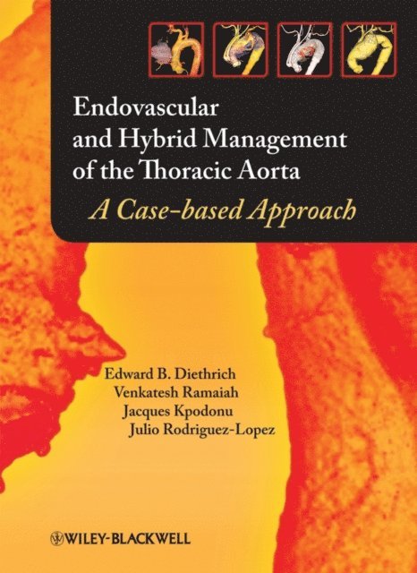 Julio A. Rodriguez-Lopez, Jacques Kpodonu, Venkatesh Ramaiah, Edward B. Diethrich - Endovascular and Hybrid Management of the Thoracic Aorta, E-bok