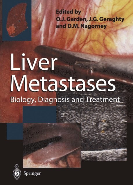 David M. Nagorney, James G. Geraghty, O. James Garden - Liver Metastases, E-bok