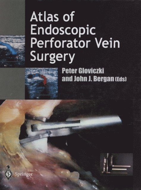 John Bergan, Peter Gloviczki - Atlas of Endoscopic Perforator Vein Surgery, E-bok