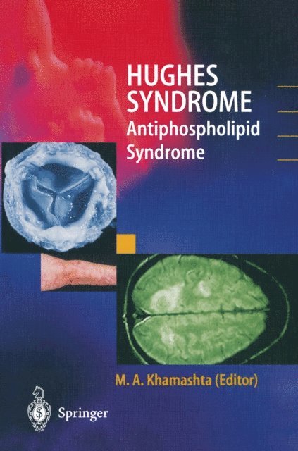 Munther A Khamashta - Hughes Syndrome, E-bok