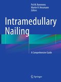 Intramedullary Nailing