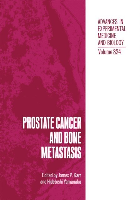 Hidetoshi Yamanaka, James P. Karr - Prostate Cancer and Bone Metastasis, E-bok