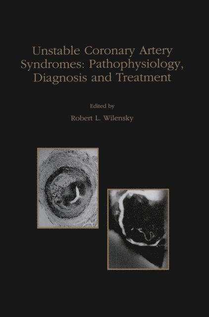 Robert L. Wilensky - Unstable Coronary Artery Syndromes Pathophysiology, Diagnosis and Treatment, E-bok