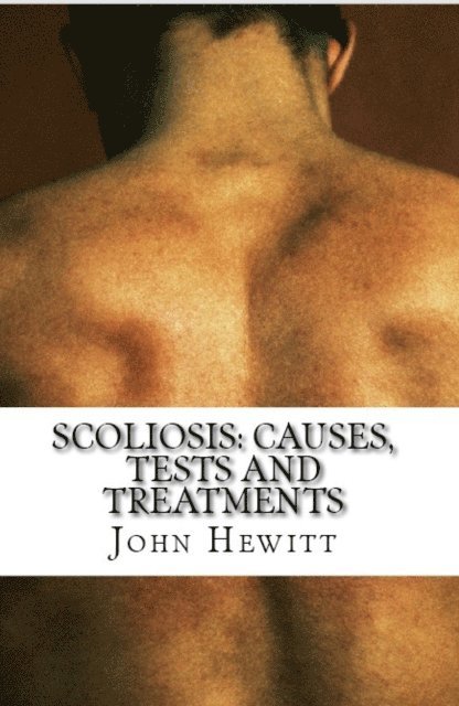 John Hewitt - Scoliosis: Causes, Tests and Treatments, E-bok