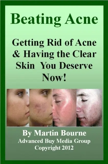 Advanced Buy Media Group - Beating Acne: Getting Rid of Acne & Having the Skin You Deserve Now!, E-bok. Tillgänglighet: Lägg i varukorg