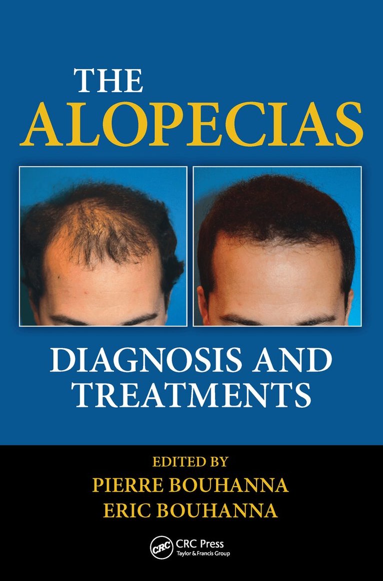 Pierre Bouhanna, Eric Bouhanna - Alopecias, E-bok
