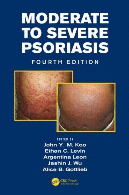 John Koo, Ethan Levin, Argentina Leon, Jashin Wu - Mild to Moderate and Moderate to Severe Psoriasis (Set), E-bok