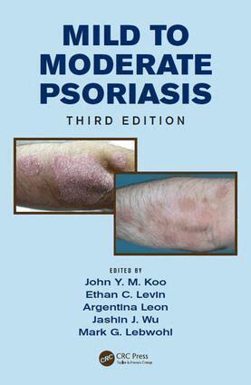 John Koo, Ethan Levin, Argentina Leon, Jashin Wu, Mark Lebwohl - Mild to Moderate Psoriasis, E-bok