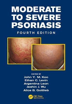 John Koo, Jashin Wu, Alice Gottlieb, Ethan Levin, Argentina Leon - Moderate to Severe Psoriasis, E-bok