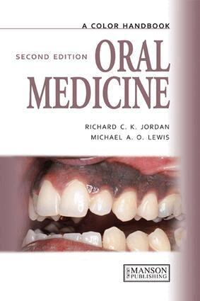 Michael Lewis, Richard Jordan - Oral Medicine, E-bok