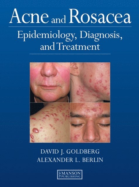 Alexander Berlin, David Goldberg - Acne and Rosacea, E-bok